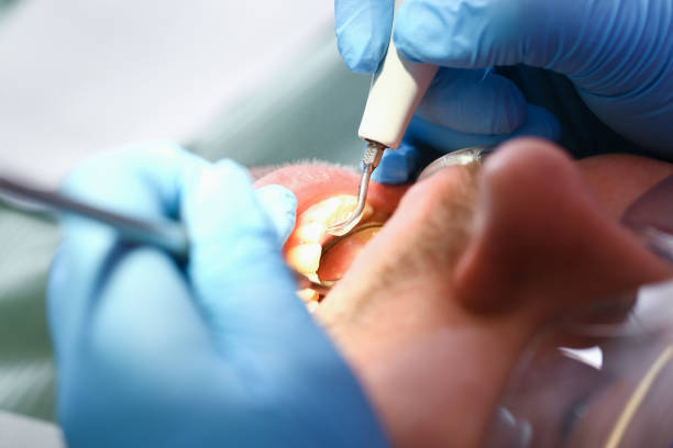 Best Emergency Dentist for Lost Fillings or Crowns in Oneida, TN
