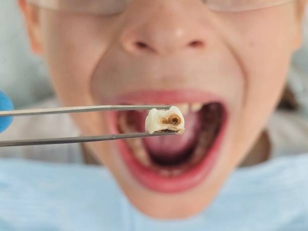 Best Broken or Cracked Tooth Emergency Dentist in Oneida, TN